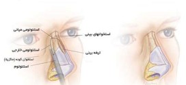 استئوتومی در جراحی بینی