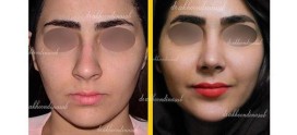 جراحی بینی +دکتر محمدرضا آخوندی نسب