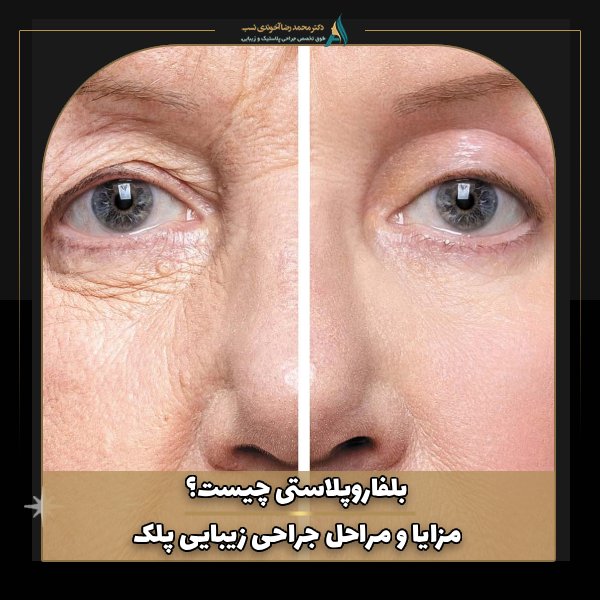 بلفاروپلاستی چیست؟ مزایا و مراحل جراحی پلک + عکس قبل و بعد