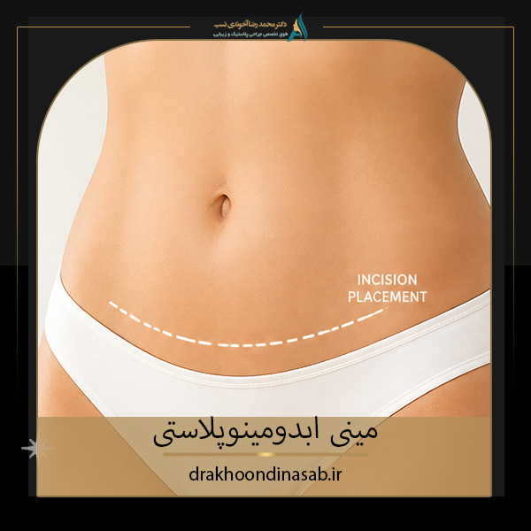 مینی ابدومینوپلاستی - دکتر اخوندی نسب