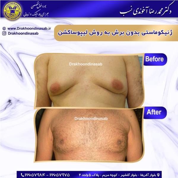 عکس قبل و بعد ژنیکوماستی