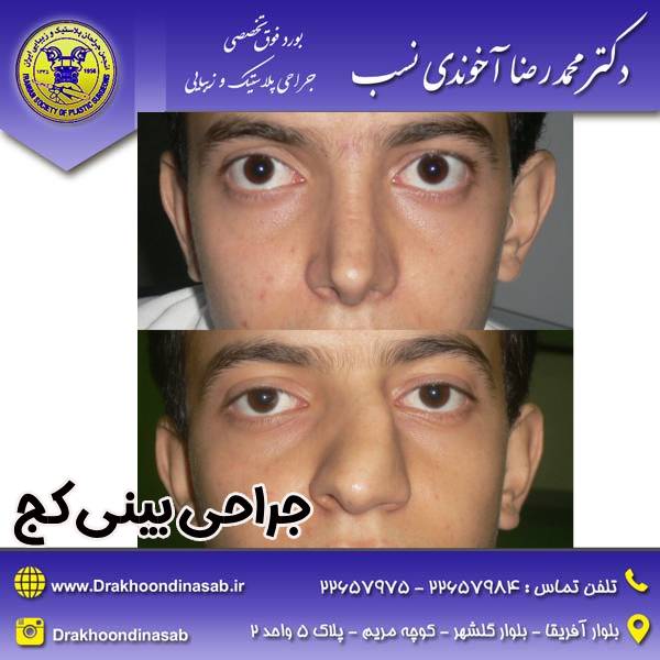 عکس جراحی بینی کج - دکتر محمدرضا آخوندی نسب