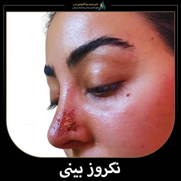 نکروز بینی + دکتر محمدرضا آخوندی نسب