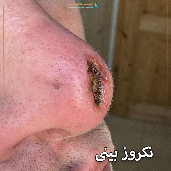 نکروز بینی + دکتر محمدرضا آخوندی نسب