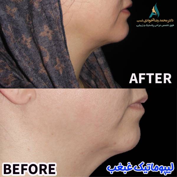 عکس لیپوماتیک غبغب