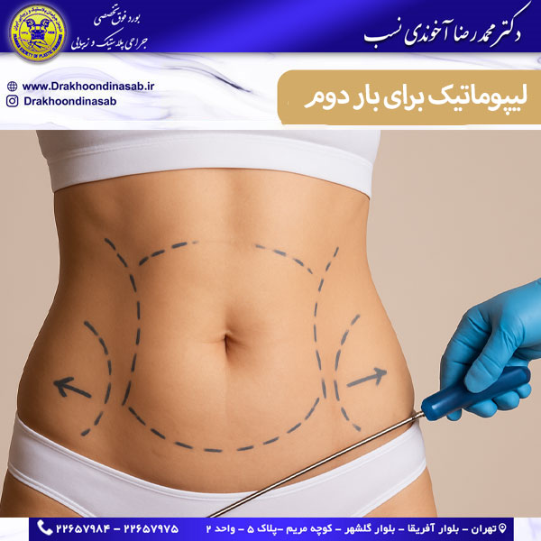 عمل لیپوماتیک شکم برای بار دوم