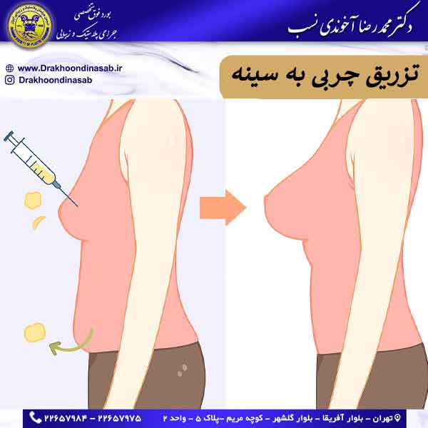 تزریق چربی به سینه