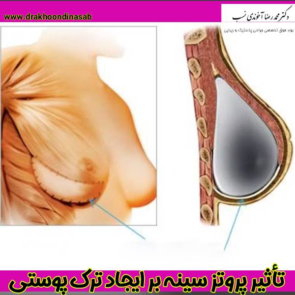 تاثیر پروتز سینه بر ترک های پوستی - دکتر محمدرضا آخوندی نسب
