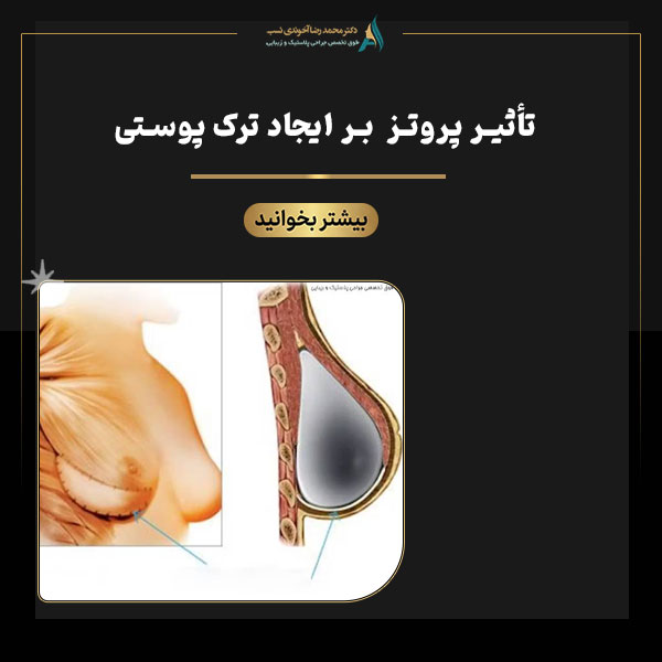 تاثیر پروتز سینه بر ترک های پوستی - دکتر محمدرضا آخوندی نسب