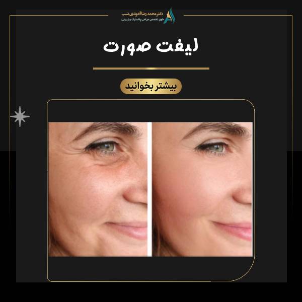 لیفت صورت - دکتر محمدرضا آخوندی نسب