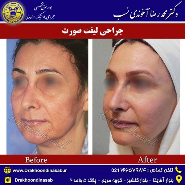 عکس قبل و بعد لیفت صورت - دکتر محمدرضا آخوندی نسب