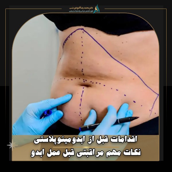 مهمترین اقدامات قبل از ابدومینوپلاستی چیست؟ نکات مراقبتی قبل عمل ابدو