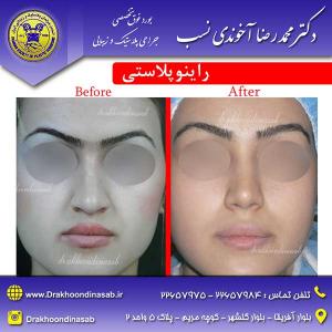 دکتر محمدرضا آخوندی نسب - راینوپلاستی