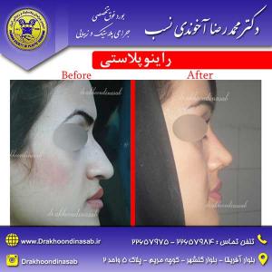 دکتر محمدرضا آخوندی نسب - راینوپلاستی