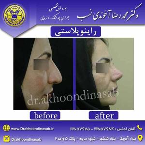 دکتر محمدرضا آخوندی نسب - راینوپلاستی
