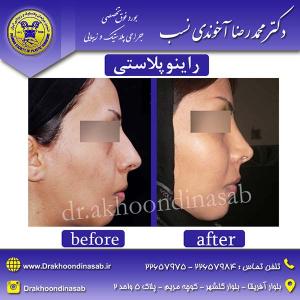 دکتر محمدرضا آخوندی نسب - راینوپلاستی