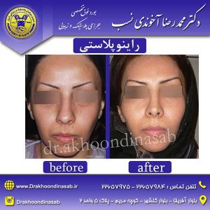 دکتر محمدرضا آخوندی نسب - راینوپلاستی
