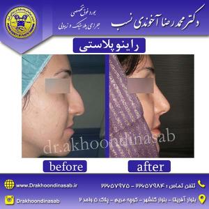 دکتر محمدرضا آخوندی نسب - راینوپلاستی