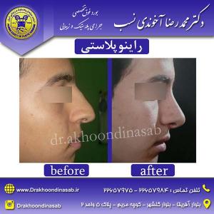 دکتر محمدرضا آخوندی نسب - راینوپلاستی
