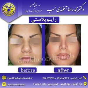 دکتر محمدرضا آخوندی نسب - راینوپلاستی