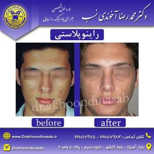 دکتر محمدرضا آخوندی نسب - راینوپلاستی