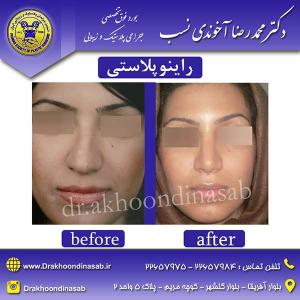 دکتر محمدرضا آخوندی نسب - راینوپلاستی