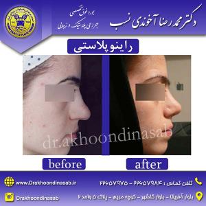 دکتر محمدرضا آخوندی نسب - راینوپلاستی