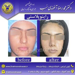 دکتر محمدرضا آخوندی نسب - راینوپلاستی