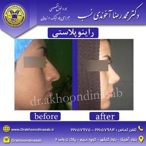 دکتر محمدرضا آخوندی نسب - راینوپلاستی
