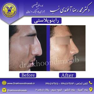 دکتر محمدرضا آخوندی نسب - راینوپلاستی