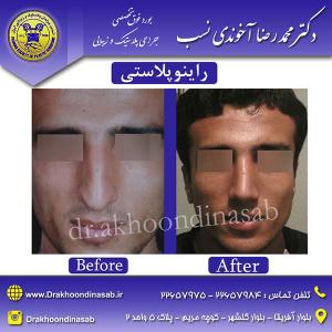 دکتر محمدرضا آخوندی نسب - راینوپلاستی