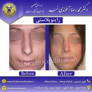 دکتر محمدرضا آخوندی نسب - راینوپلاستی