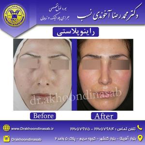 دکتر محمدرضا آخوندی نسب - راینوپلاستی