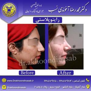 دکتر محمدرضا آخوندی نسب - راینوپلاستی