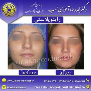 دکتر محمدرضا آخوندی نسب - راینوپلاستی