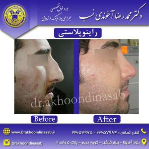 دکتر محمدرضا آخوندی نسب - راینوپلاستی
