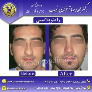 دکتر محمدرضا آخوندی نسب - راینوپلاستی