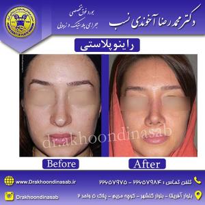 دکتر محمدرضا آخوندی نسب - راینوپلاستی