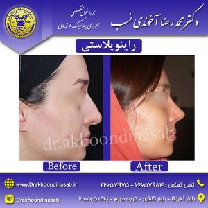 دکتر محمدرضا آخوندی نسب - راینوپلاستی