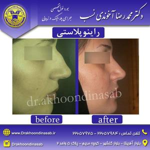 دکتر محمدرضا آخوندی نسب - راینوپلاستی