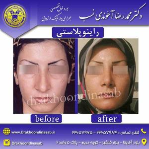 دکتر محمدرضا آخوندی نسب - راینوپلاستی