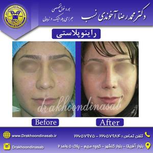 دکتر محمدرضا آخوندی نسب - راینوپلاستی