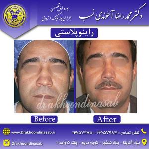 دکتر محمدرضا آخوندی نسب - راینوپلاستی