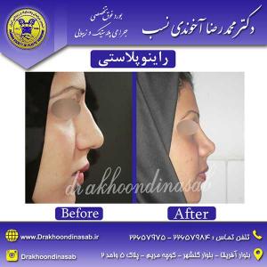 دکتر محمدرضا آخوندی نسب - راینوپلاستی