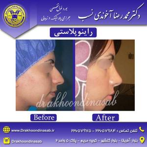 دکتر محمدرضا آخوندی نسب - راینوپلاستی