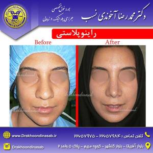 دکتر محمدرضا آخوندی نسب - راینوپلاستی