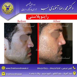 دکتر محمدرضا آخوندی نسب - راینوپلاستی