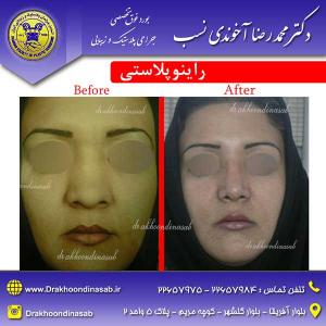 دکتر محمدرضا آخوندی نسب - راینوپلاستی