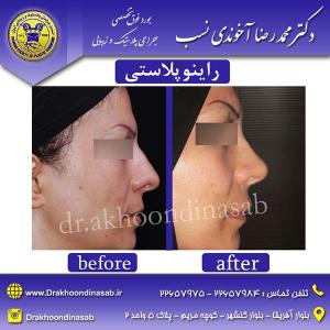 دکتر محمدرضا آخوندی نسب - راینوپلاستی