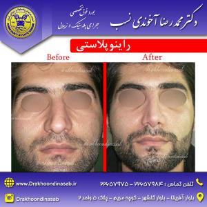 دکتر محمدرضا آخوندی نسب - راینوپلاستی